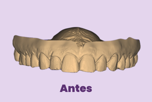 Antes