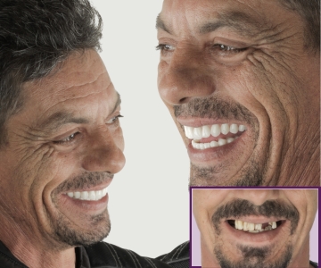 Antes e Depois