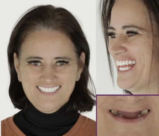 Antes e Depois